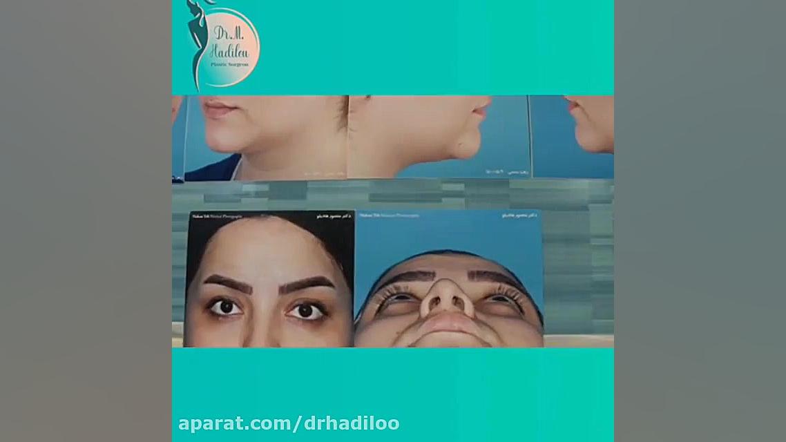فیلمی کامل و بدون سانسور از اتاق عمل جراحی بینی استخوانی لیفت گردنایمپلنت دندان