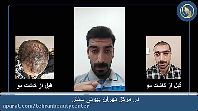 کاشت مو تهران بیوتی سنتر ایمپلنت مغز-ماشین