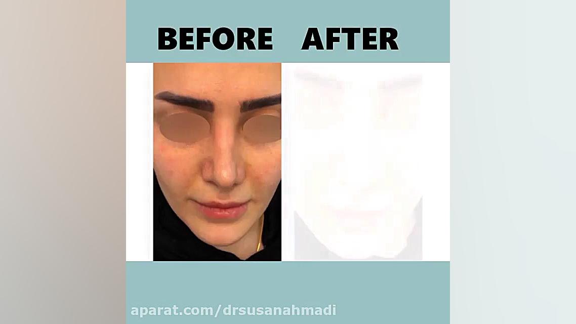 فیلم زاویه سازی صورت با تزریق چربی به روش میکروفت دکتر سوسن احمدی پیر شهید