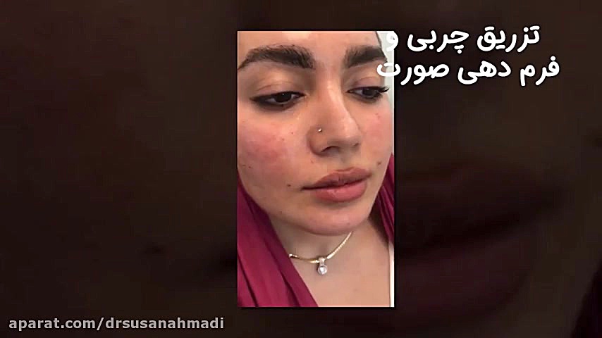 تزریق چربی، بهترین روش برای فرم دهی صورت دکتر سوسن احمدی پیر شهید