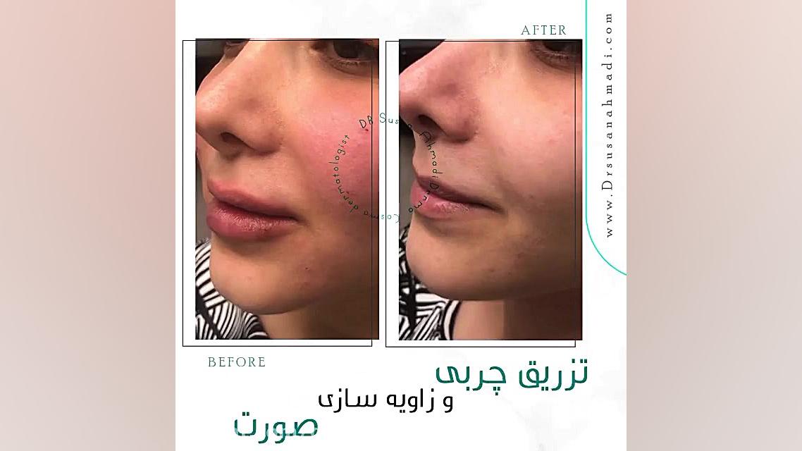 فیلم فرم دهی و زاویه سازی صورت با تزریق چربی دکتر سوسن احمدی پیر شهید