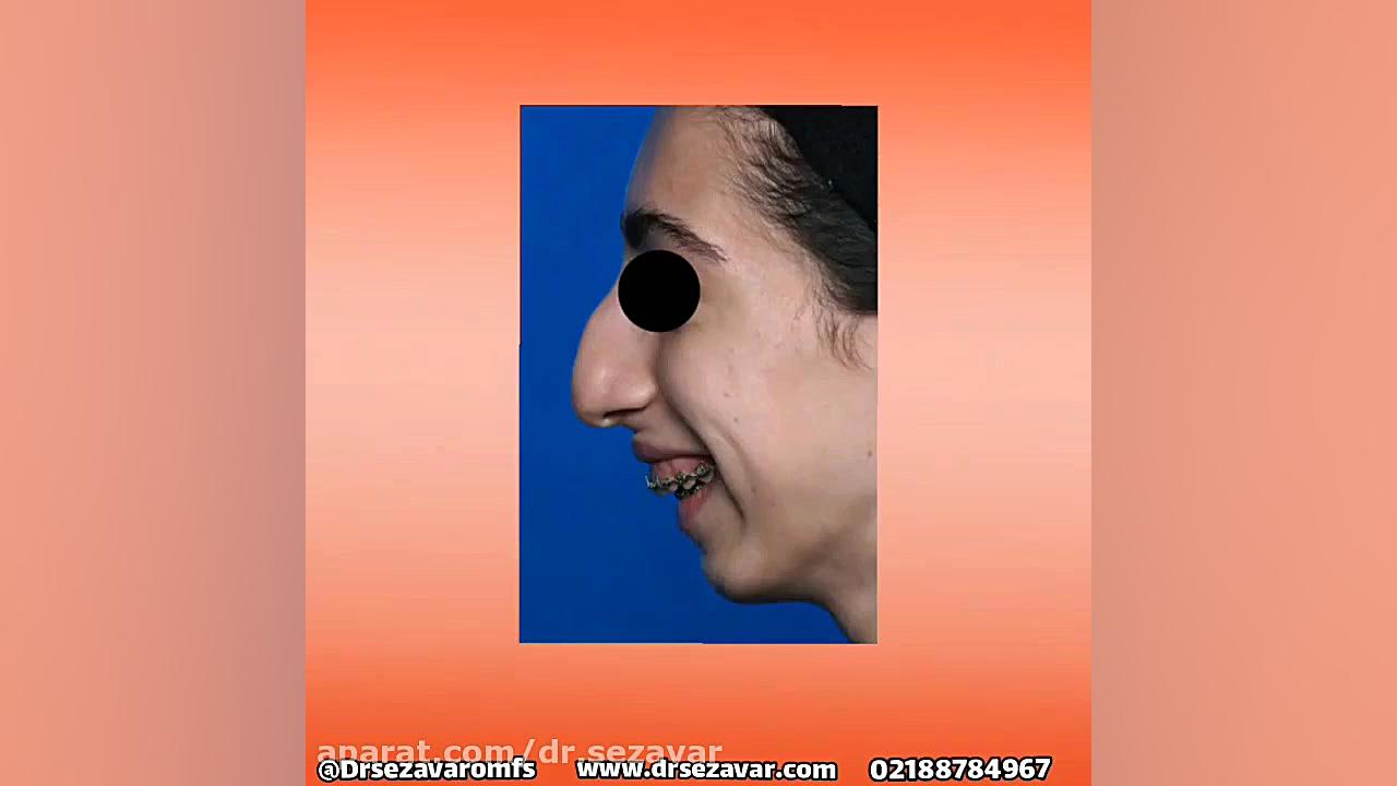 جراحی فک و صورت اکتروپیون