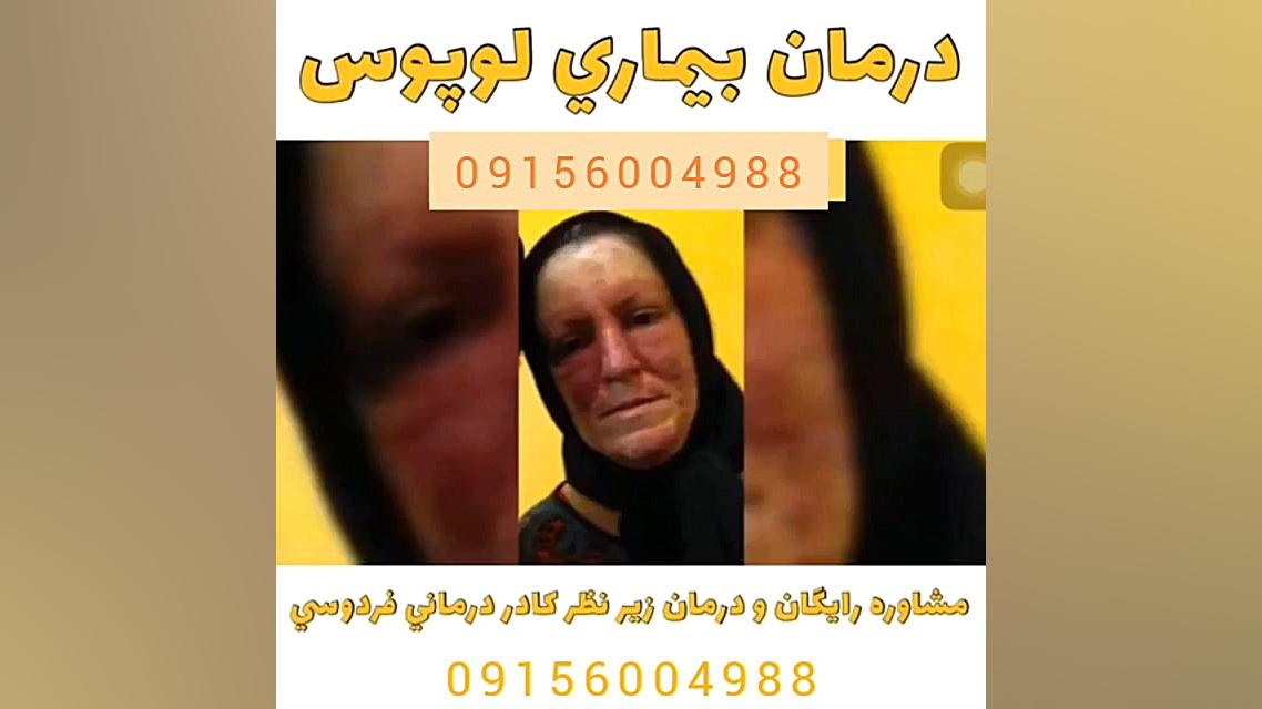 لوپوس چیست؟وچگونه می توان آن را درمان کرد؟ تزریق ژل