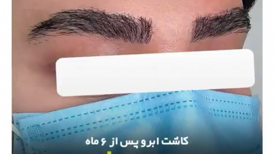کاشت ابرو پس از 6 ماه - بدون جراحی | عوارض جانبی تاتو و هاشور ابرو ایریدوتيكان