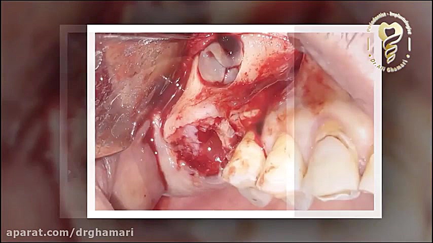 فیلم جراحی ایمپلنت 5 دندان همزمان در فک بالا و پایین Autophagy Detection Kit