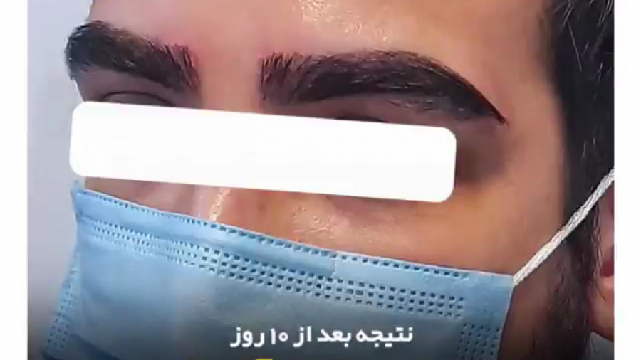 کاشت ابرو آقایان - نتیجه کاشت ابرو بعد از 10 روز ارنیزوماب