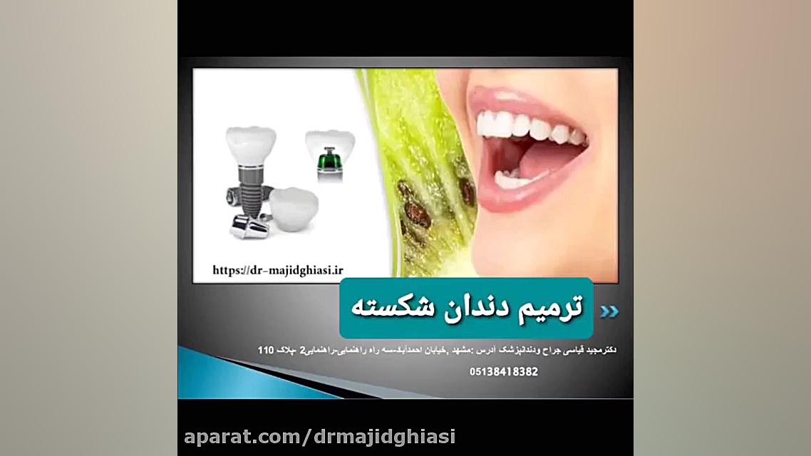 ترمیم شکستگی دندان دکترمجیدقیاسی
