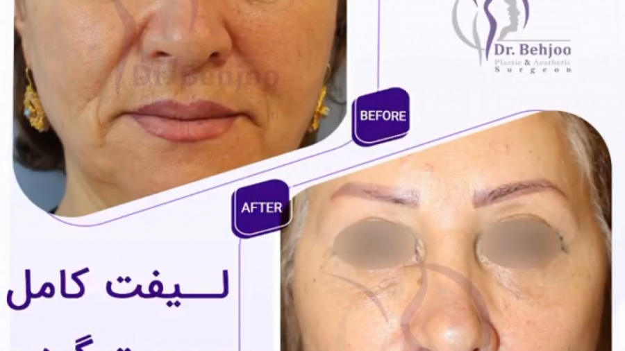 فیلم جراحی ليفت كامل صورت،گردن و پيشانى دکتر شاهین بهجو - فوق تخصص جراحی پلاستیک