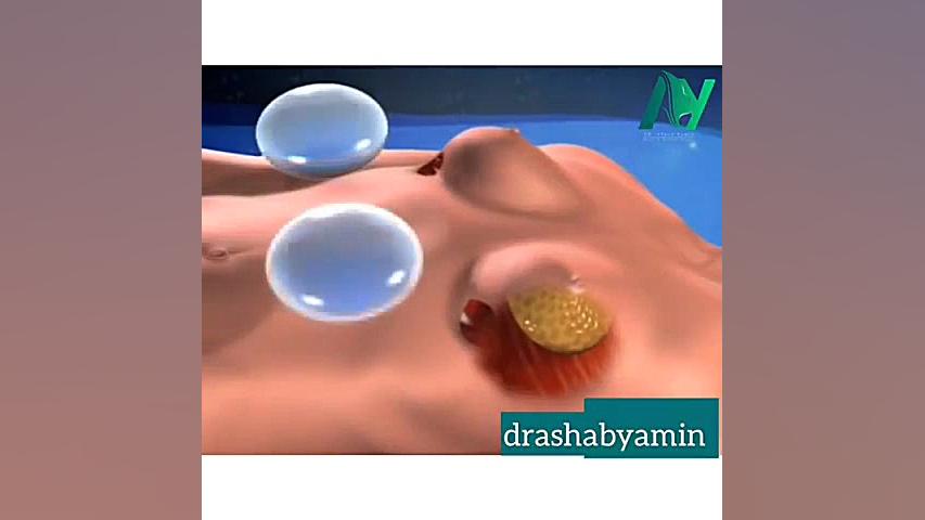 انیمیشنی از عمل پروتز سینه پمپ انسولین ایمپلنتی