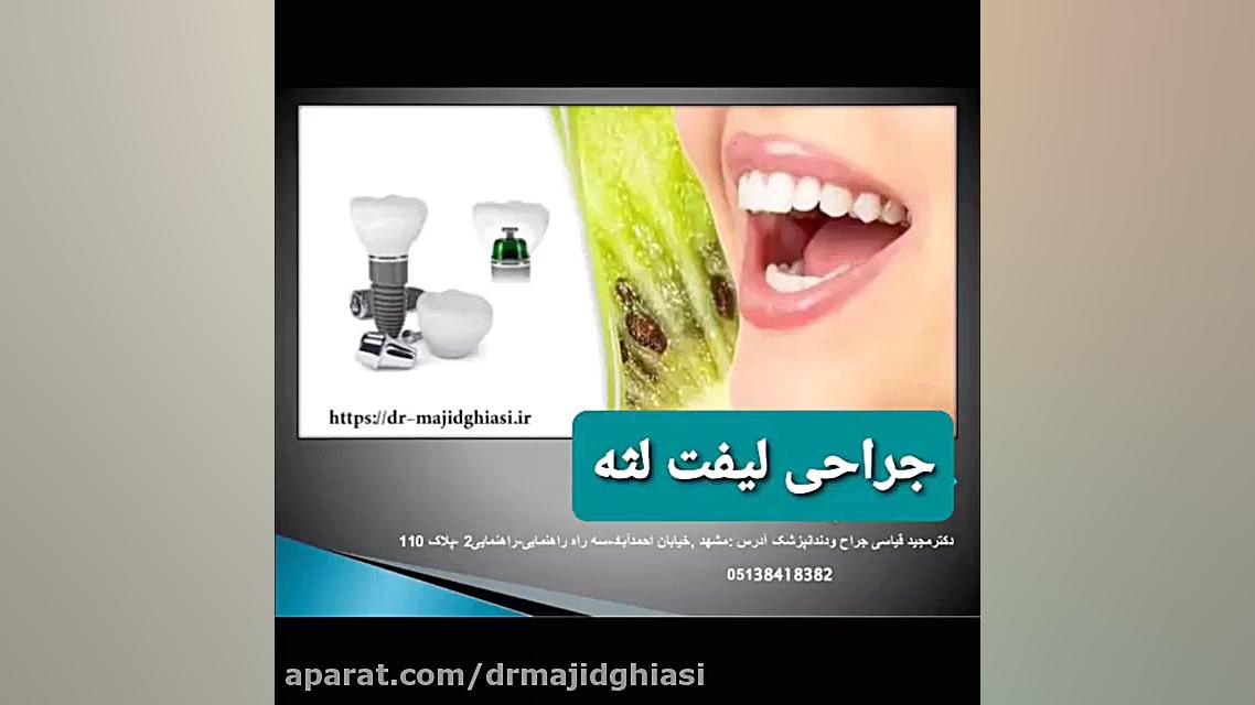 جراحی لیفت لثه دکترمجیدقیاسی