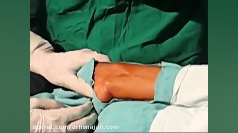 آنژیوگرافی از راه دست جراحی لثه