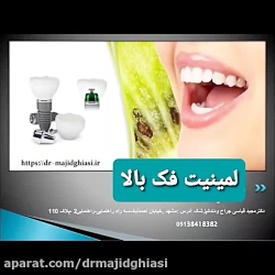 لمینت فک بالا