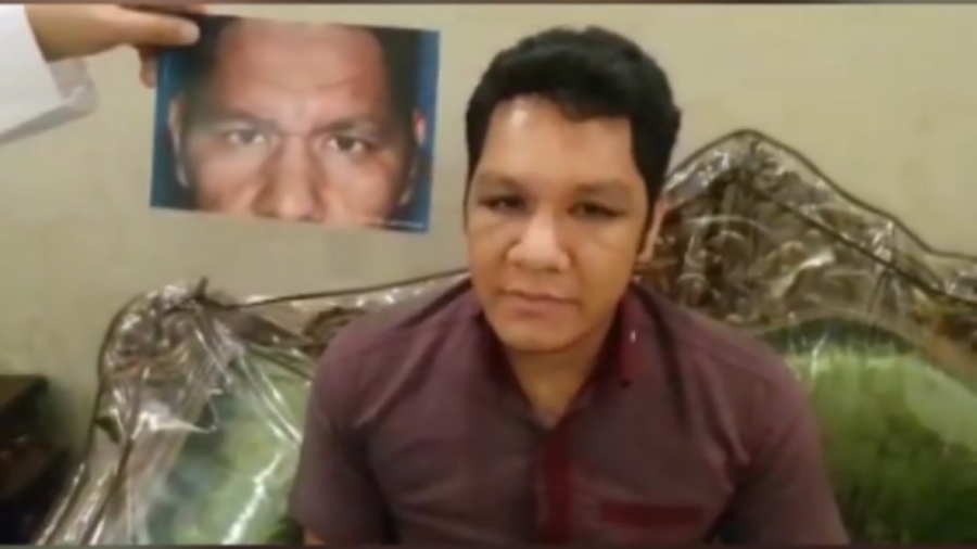 لیفت پیشانی به همراه تراش استخوان انتروپیون