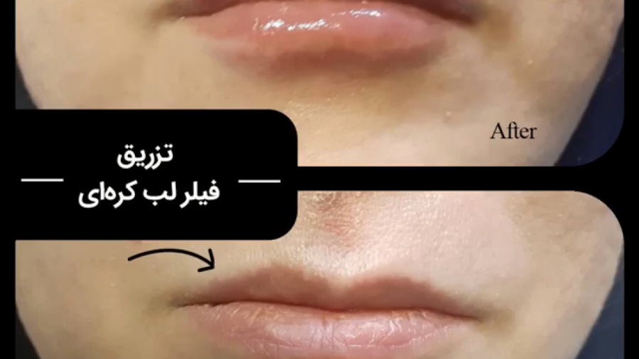 تزریق فیلر لب کره ای (دکتر مرضیه صحت پور)drmarziyesehatpour