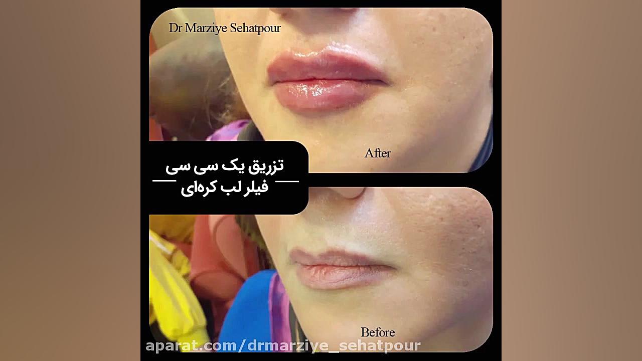 تزریق یک سی سی فیلر لب کره ای (دکتر مرضیه صحت پور)drmarziyesehatpour