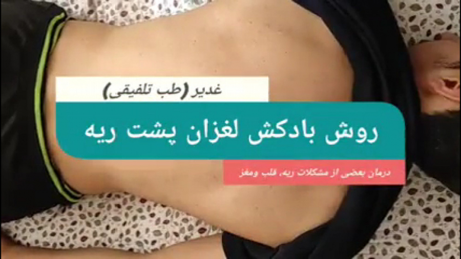 درمان عمده مشکلات ریه و قلب و‌مغز با بادکش لغزان پشت ریه(عالی دفع عوارض‌‌کرونا) گوگوش