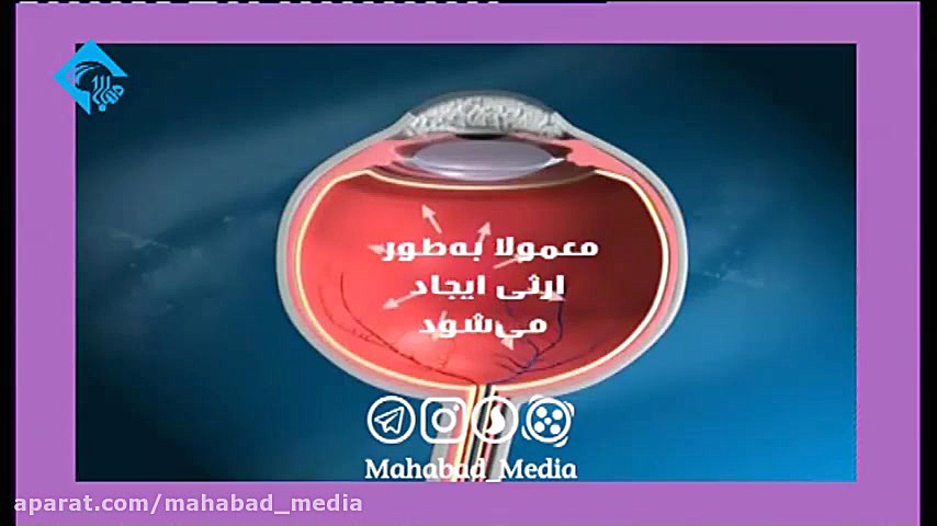آب سیاه چشم چیست؟ درمان سلولیت