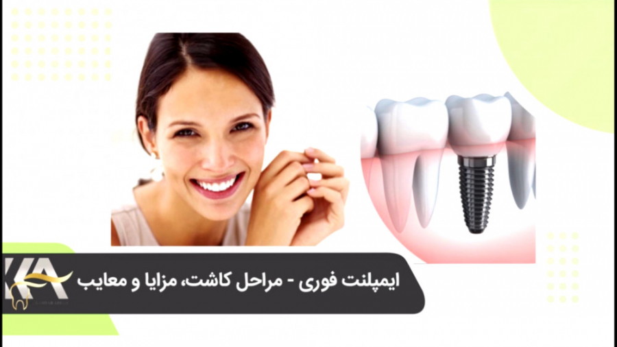 ایمپلنت فوری - مراحل کاشت، مزایا و معایب دکتر کامیار عباسی