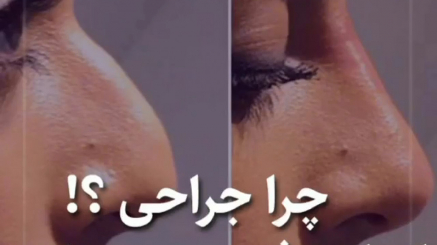 فیلم تزریق فیلر به بینی دکتر حمیده آقایی