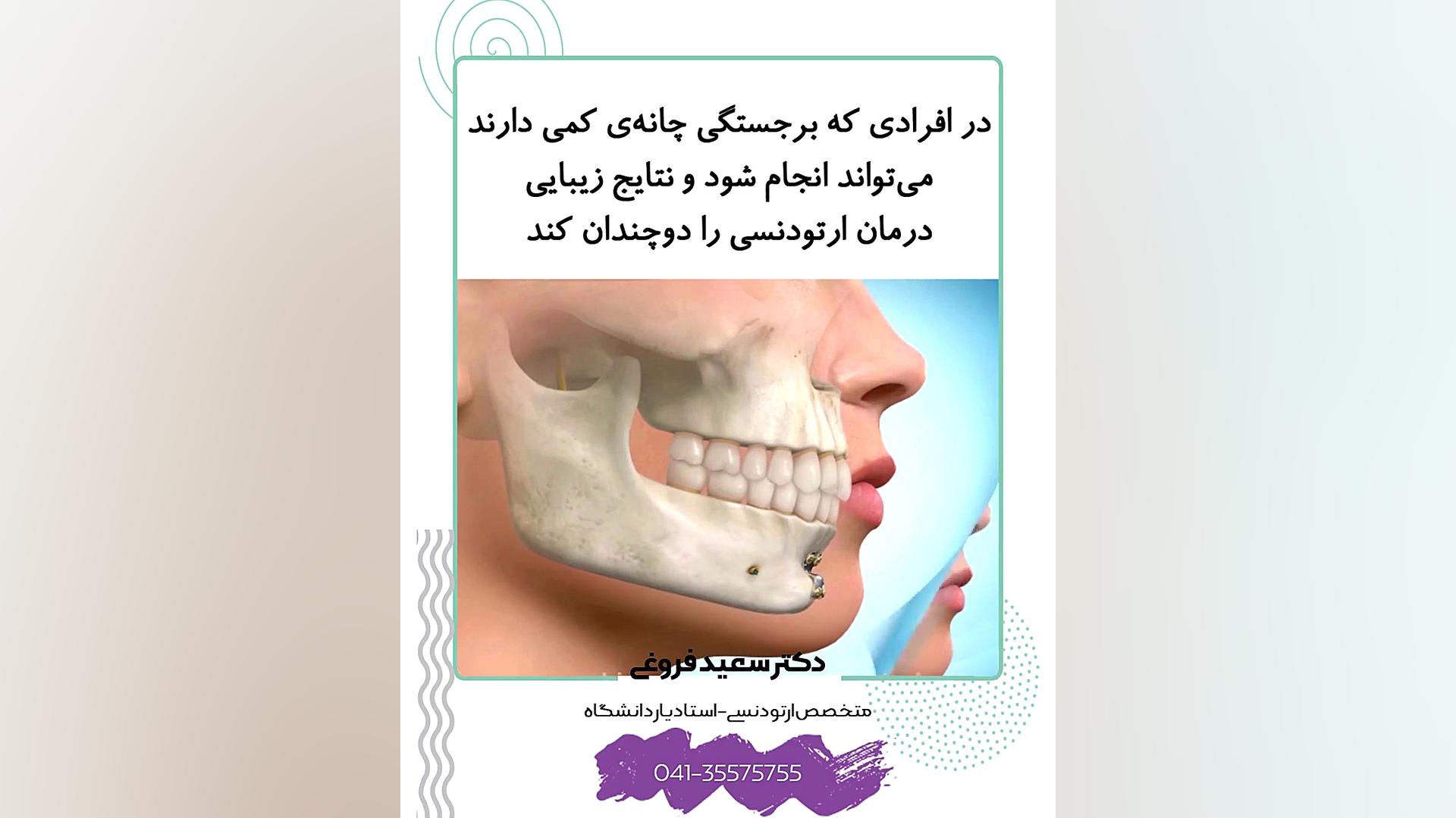 جراحی چانه (جنیوپلاستی) دکتر سعید فروغی متخصص ارتودنسی