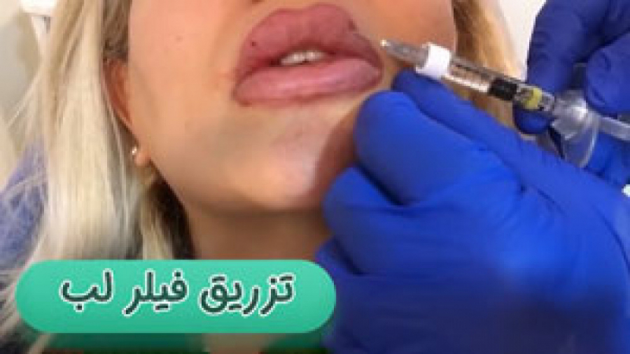 فیلم تزریق فیلر لب دکتر سوسن احمدی پیر شهید