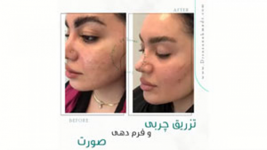 فیلم فرم دهی صورت بلافاصله پس از تزریق چربی دکتر سوسن احمدی پیر شهید