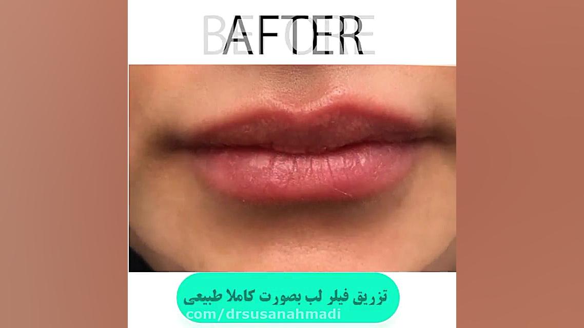 فیلم تزریق فیلر لب طبیعی دکتر سوسن احمدی پیر شهید