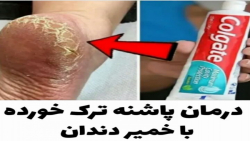 کلیپ درمان پاشنه ترک خورده . رفع ترک پا سریع . با خمیردندان
