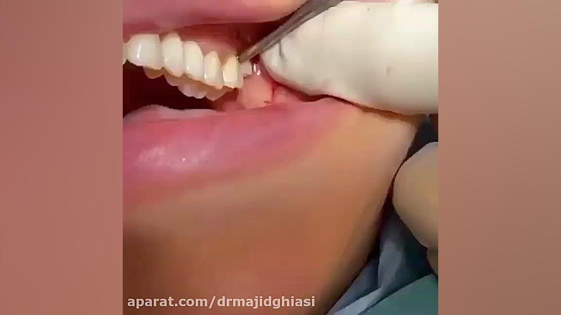 جراحی دندان عقل دکترمجیدقیاسی