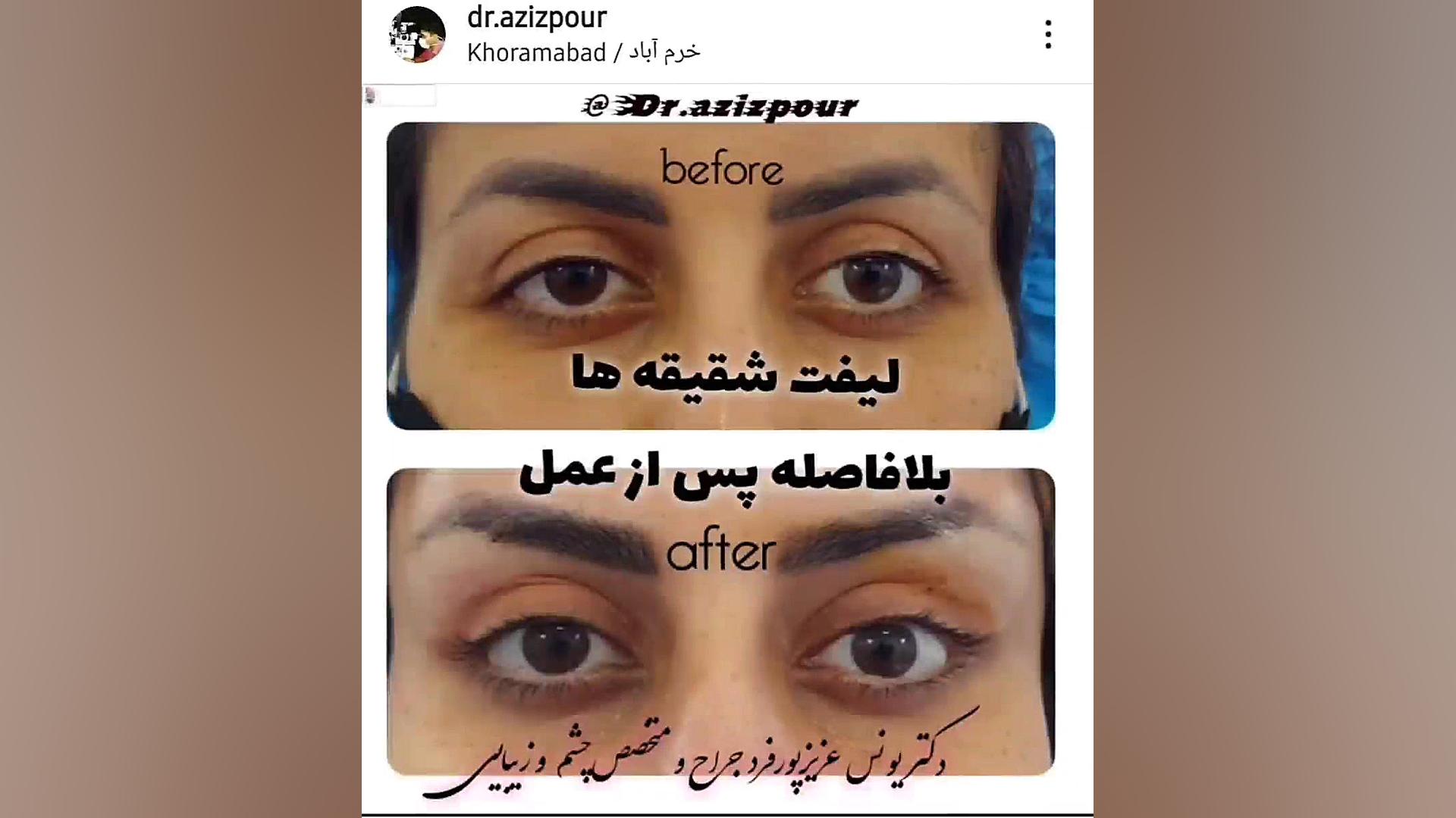 لیفت ابرو لیفت شقیقه خرم آباد کلینیک مو