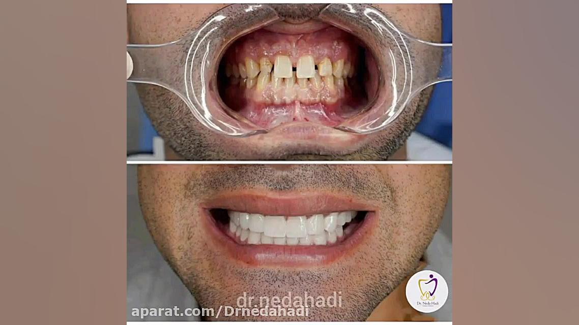 فیلم واقعی از نحوه انجام لمینت دندان دکتر ندا هادی-دندانپزشک زیبایی
