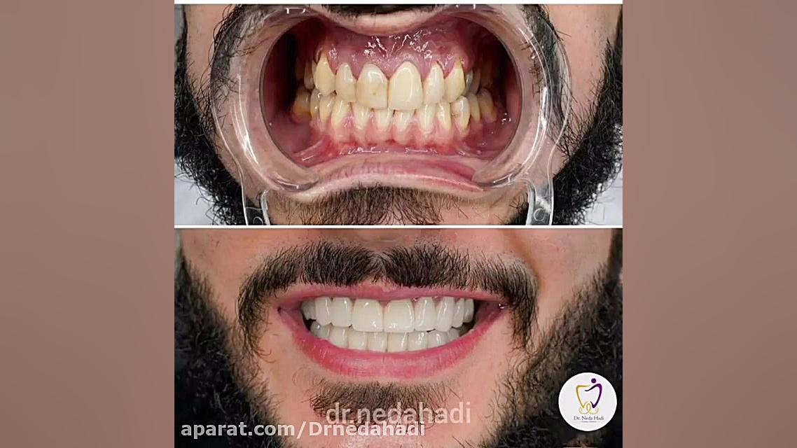 انجام خدمات زیبایی دندان برای مراجعه کننده عزیز دکتر ندا هادی-دندانپزشک زیبایی