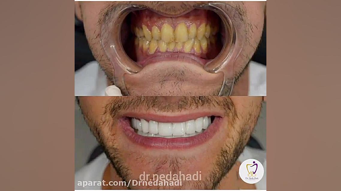 بیست واحد لمینت برای زیباجوی عزیز در مطب دکتر ندا هادی دکتر ندا هادی-دندانپزشک زیبایی