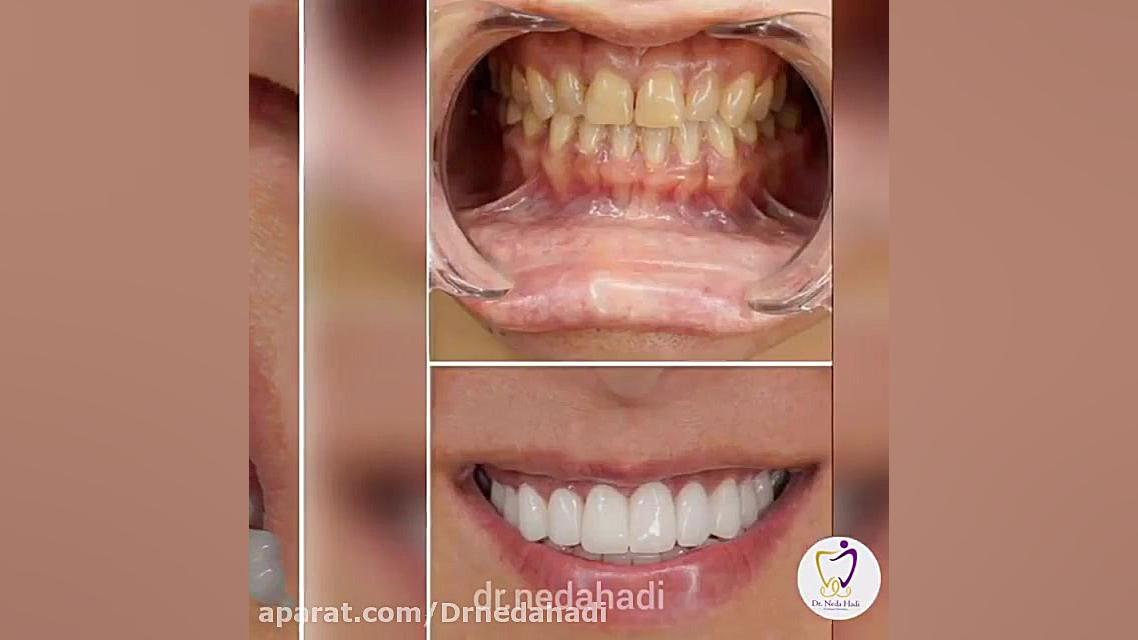 فیلم از انجام خدمات زیبایی دندان در مطب دکتر ندا هادی-دندانپزشک زیبایی