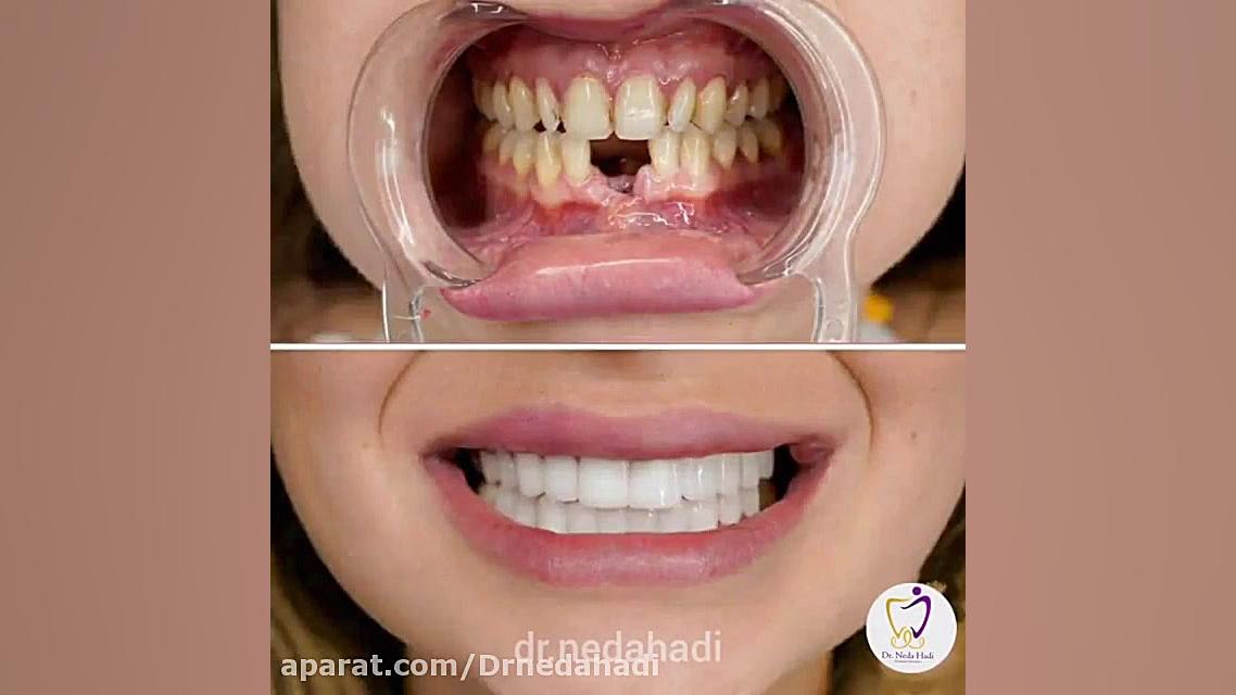 فیلم واقعی درمان ترکیبی لمینت و ایمپلنت برای زیباجو دکتر ندا هادی-دندانپزشک زیبایی