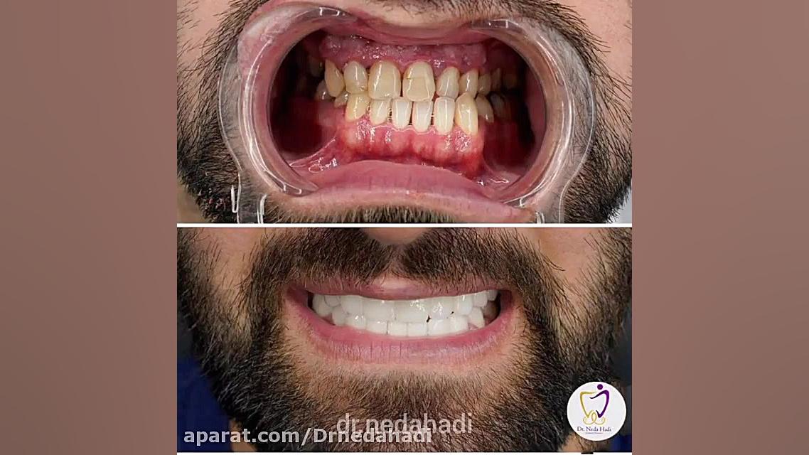 فیلم 20 واحد لمینت دندان برای مراجعه کننده عزیز دکتر ندا هادی-دندانپزشک زیبایی