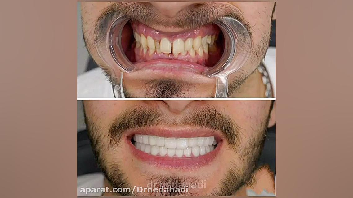 انجام 20 واحد لامینیت برای زیباجوی عزیز در مطب دکتر ندا هادی-دندانپزشک زیبایی