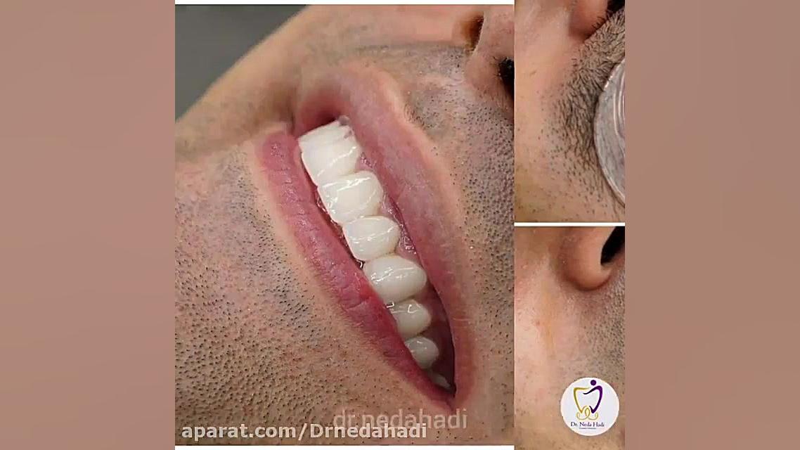 فیلم واقعی از انجام لمینت دندان در مطب دکتر ندا هادی دکتر ندا هادی-دندانپزشک زیبایی