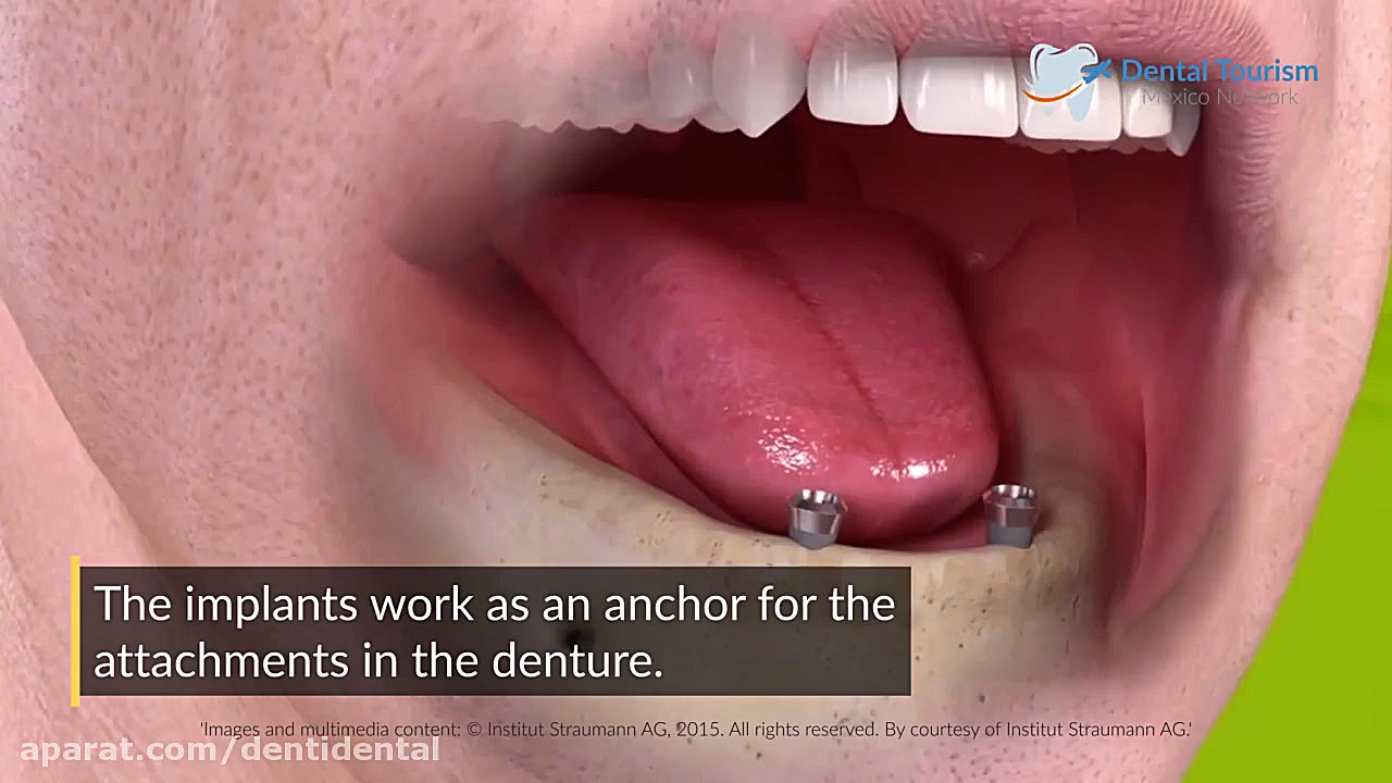 ایمپلنت دندان ایمپلنت های دندانی Piedras Negras Dental Screening Lentiviral Vector
