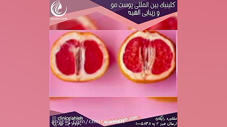 تفاوت دستگاه تناسلی دختران و زنان و عمل زیبایی بیماری منیر