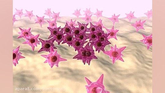 ملانوما جراحی لثه