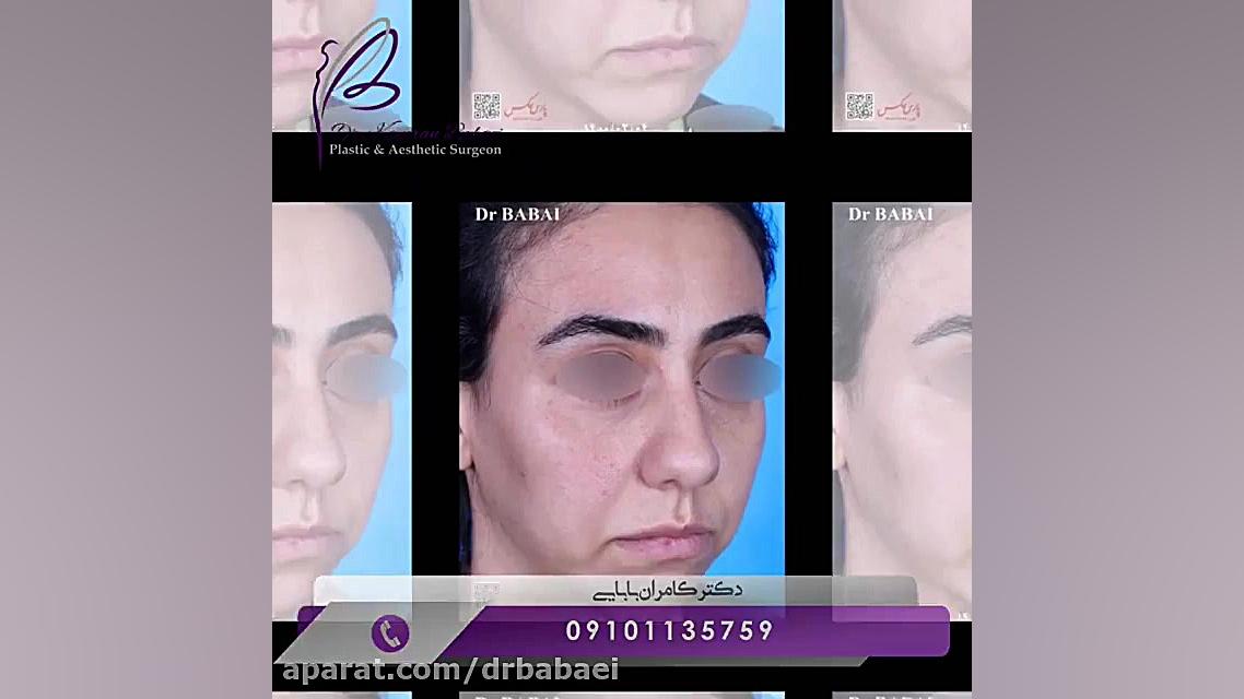 فیلم بدون سانسور عمل زیبایی بینی دکتر کامران بابایی