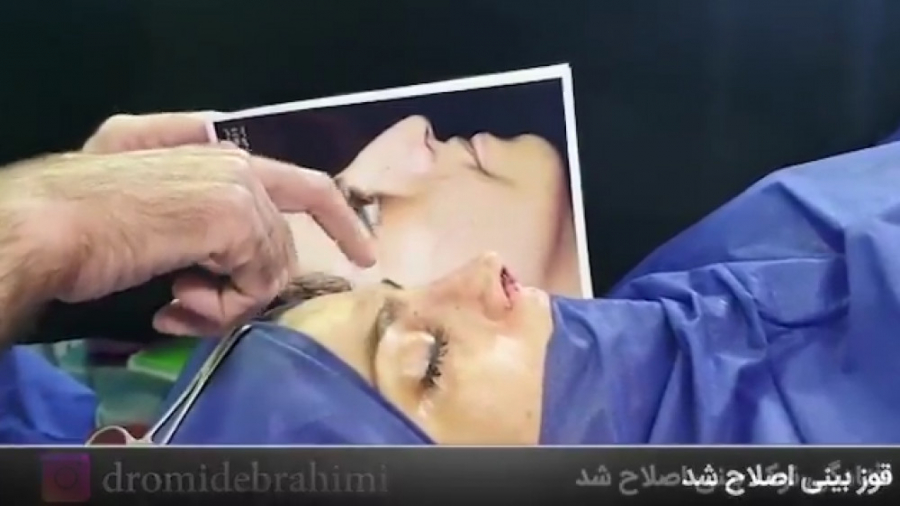 جراحی انحراف بینی استخوانی توسط دکتر امید ابراهیمی بهترین جراح بینی در تهران دکتر امید ابراهیمی