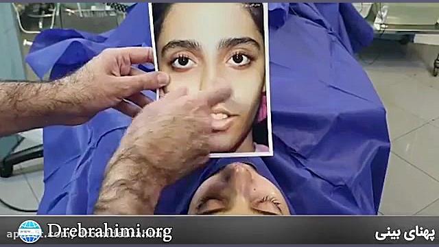 عمل زیبایی بینی استخوانی توسط دکتر امید ابراهیمی دکتر امید ابراهیمی
