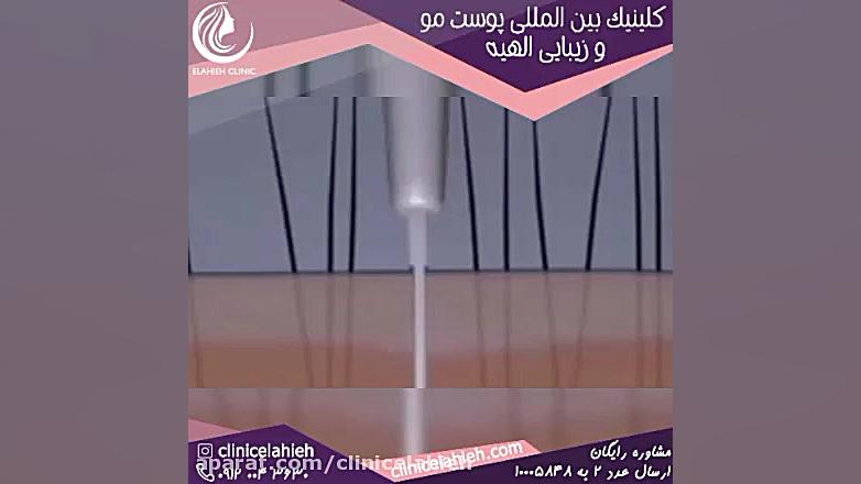 بهترین دکتر پوست و مو در تهران اولتراسوند پرتابل جیبی