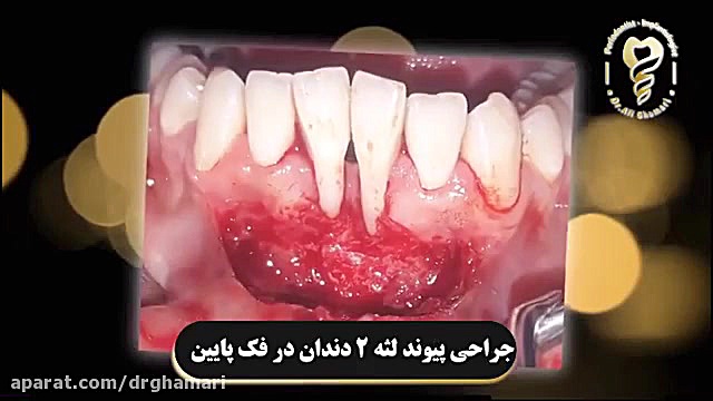 فیلم جراحی پیوند لثه ۲ دندان به صورت همزمان در فک پایین دکتر علی قمری - متخصص جراحی لثه و ایمپلنت