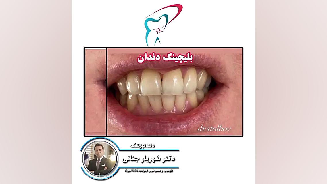 بلیچینگ دندان DLCO