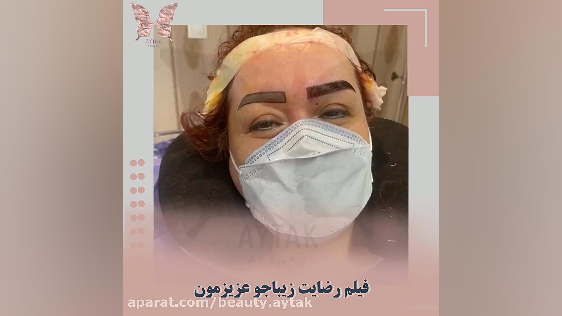 فیلم پیوند ابرو طبیعی و نظر زیباجوی عزیز | مرکز کاشت آیتک | رفع غبغب