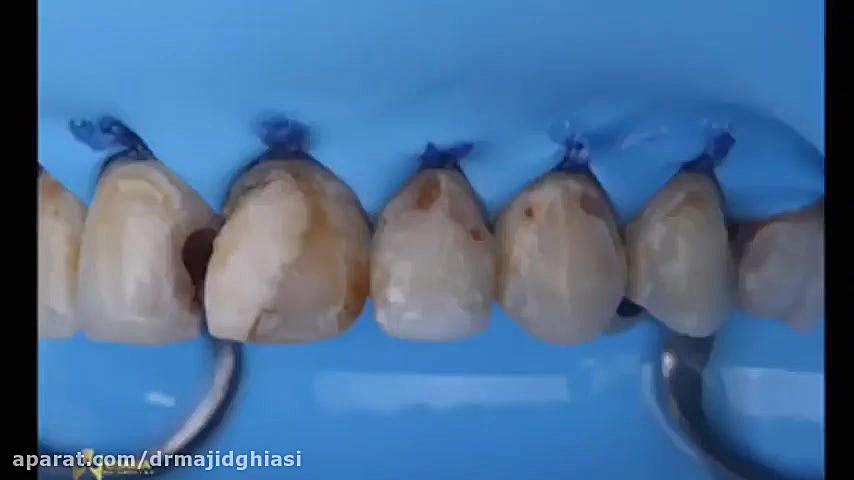 اصلاح طرح لبخند با کامپوزیت ونیر دکترمجیدقیاسی