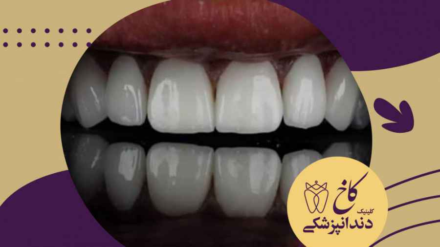 لامینت پرسلن دندان کلینیک دندانپزشکی کاخ